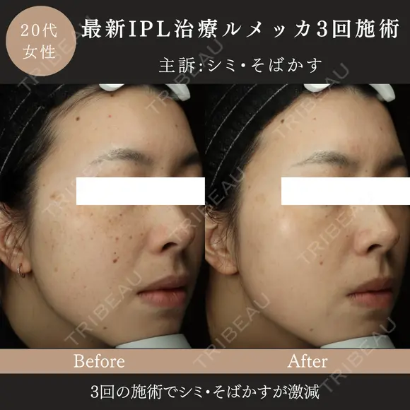 ルメッカ(IPL治療) after画像 メイン用