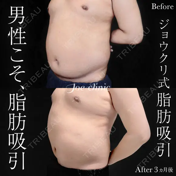脂肪吸引（上下腹部） before画像 メイン用