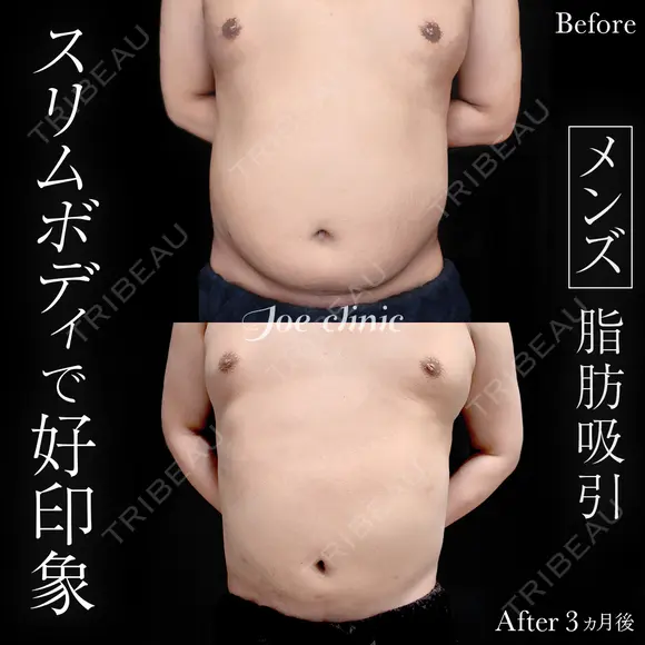 脂肪吸引（上下腹部） 90日後 メイン用