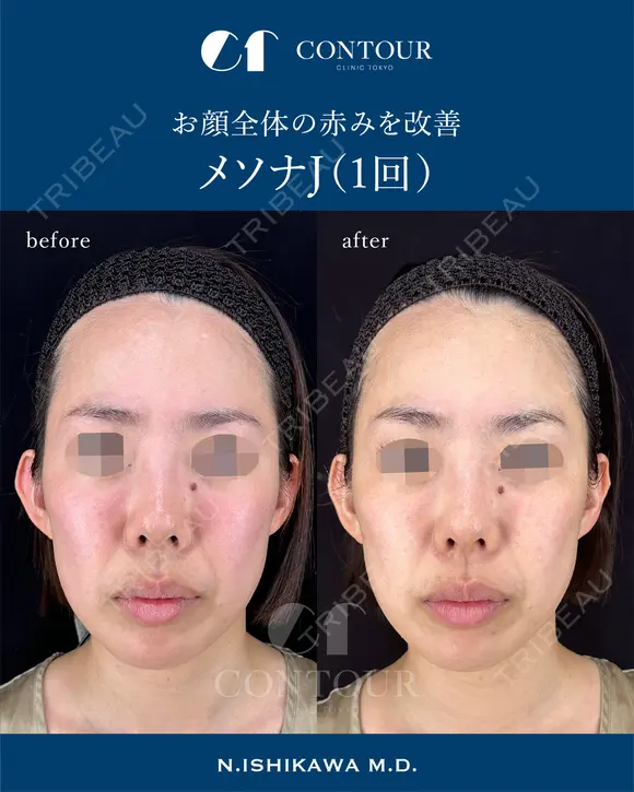メソナJ 0日後 メイン用