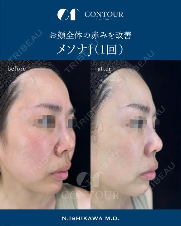 メソナJ before画像 メイン用