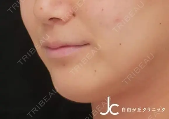 ヒアルロン酸注射 after画像 メイン用