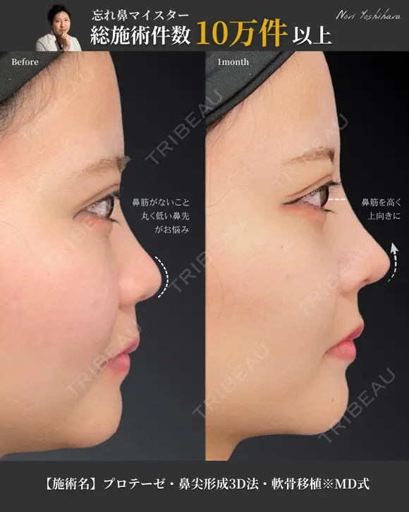プロテーゼ ・鼻尖形成3D法 ・軟骨移植 ※MD式 before画像 メイン用