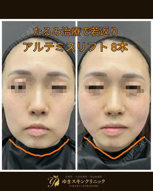 糸リフトで一気にシャープな輪郭に😌✨ after画像 メイン用