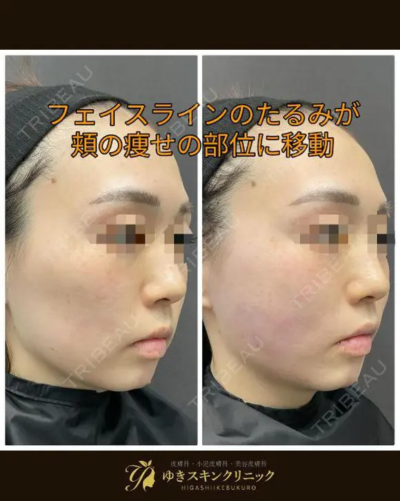 糸リフトで一気にシャープな輪郭に😌✨ after画像 メイン用