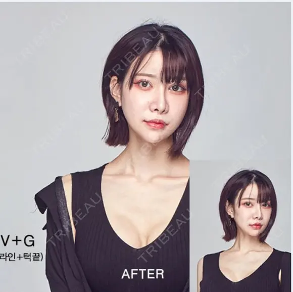 両顎+輪郭2点 after画像 メイン用