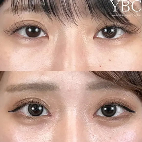 【💖涙袋ヒアルロン酸💖】 before画像 メイン用