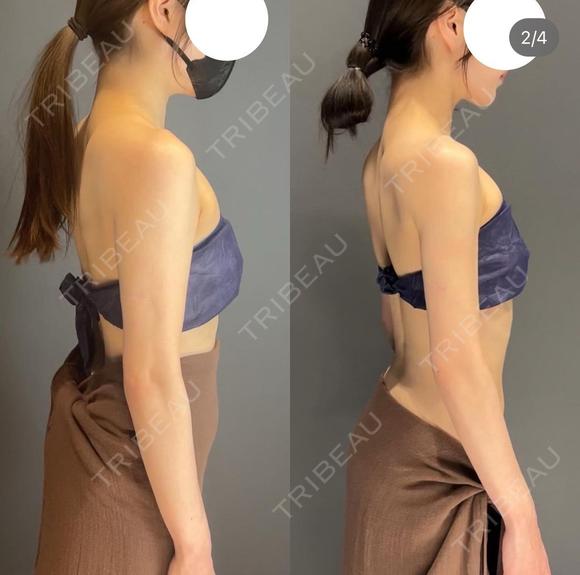 ベイザー脂肪吸引二の腕+肩 before画像 メイン用