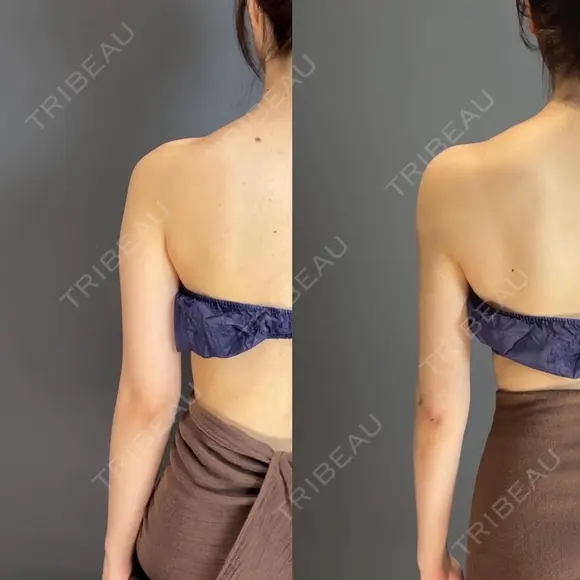 ベイザー脂肪吸引二の腕全周 before画像 メイン用