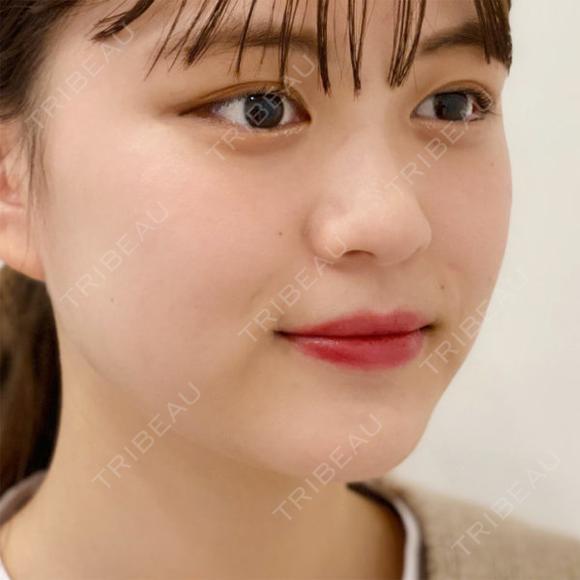 エラ張り解消でスッキリとしたフェイスラインに♪処置後1ヵ月の症例です【小顔エラボトックス注射】 30日後 メイン用