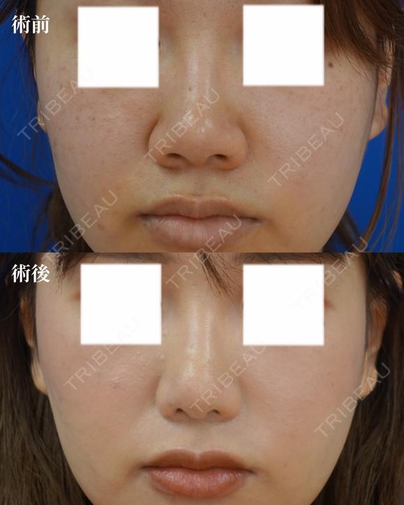 鼻尖縮小+鼻翼縮小（外側） before画像 メイン用