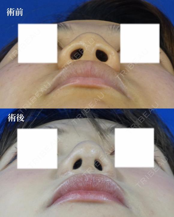 鼻尖縮小+鼻翼縮小（外側） after画像 メイン用