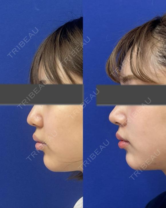 鼻尖縮小＋鼻尖部耳介軟骨移植 before画像 メイン用