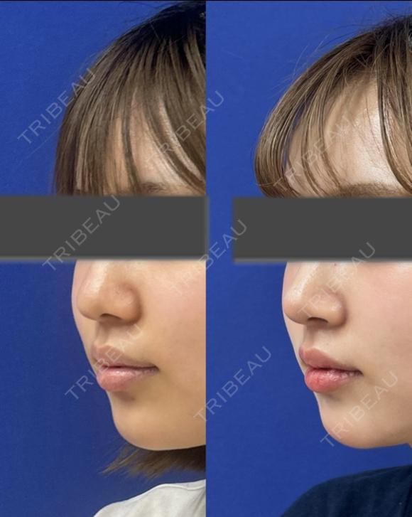 鼻尖縮小＋鼻尖部耳介軟骨移植 after画像 メイン用