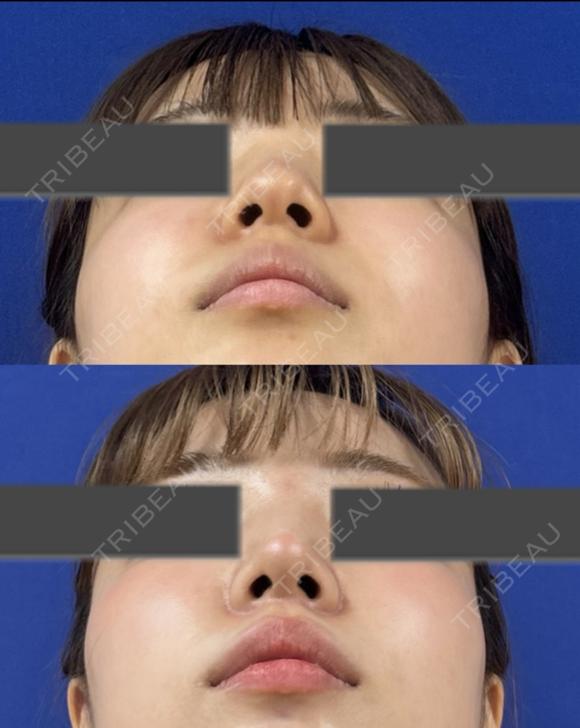 鼻尖縮小＋鼻尖部耳介軟骨移植 after画像 メイン用