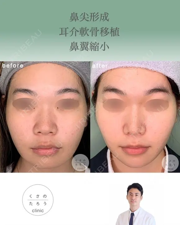 鼻尖形成＋耳介軟骨移植＋鼻翼縮小 after画像 メイン用