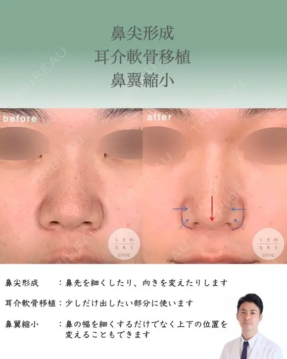 鼻尖形成＋耳介軟骨移植＋鼻翼縮小 after画像 メイン用
