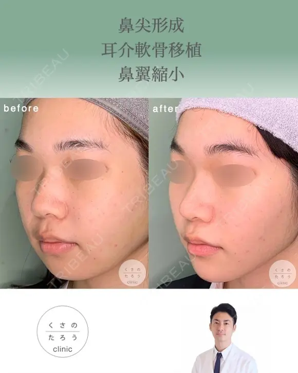 鼻尖形成＋耳介軟骨移植＋鼻翼縮小 after画像 メイン用