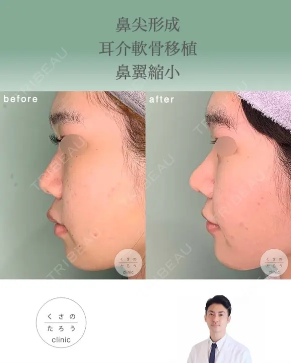 鼻尖形成＋耳介軟骨移植＋鼻翼縮小 after画像 メイン用