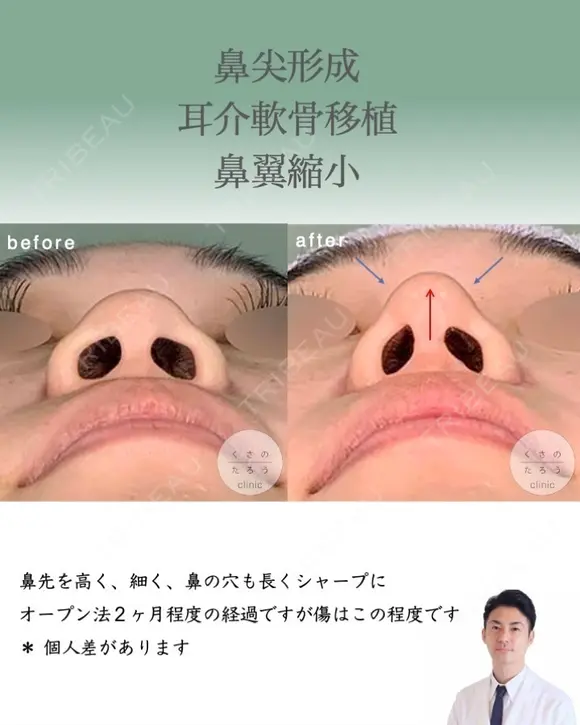 鼻尖形成＋耳介軟骨移植＋鼻翼縮小 after画像 メイン用