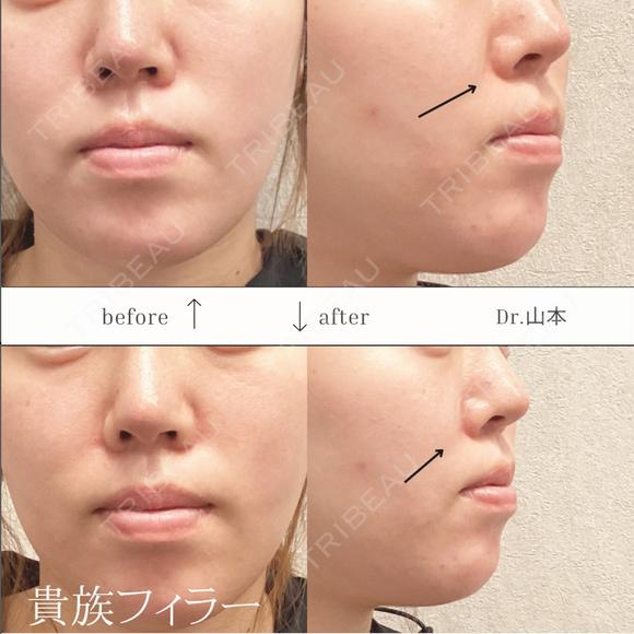 貴族フィラー　ボリューマ1cc after画像 メイン用