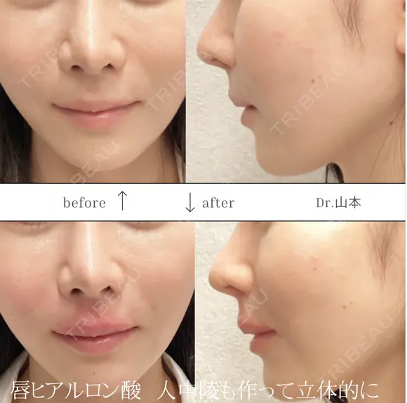 唇ヒアルロン酸　ボリフト1cc  e-ライン+人中陵 形成 before画像 メイン用