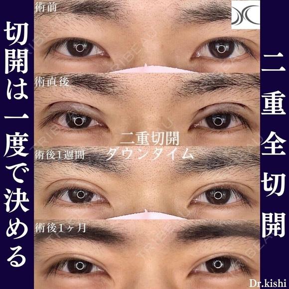 二重全切開✨ 30日後 メイン用