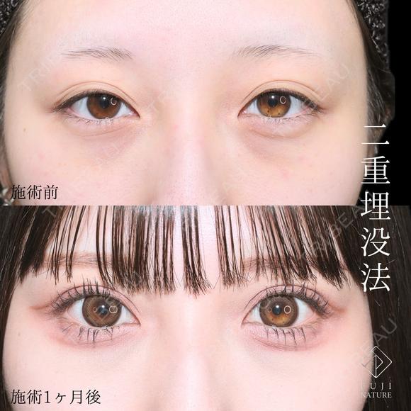 選べるオーダメイド二重埋没法 after画像 メイン用