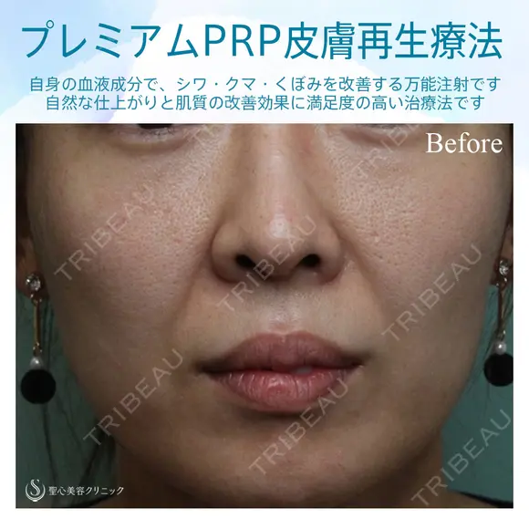 【女性・ほうれい線、たるみ改善後２年経過】プレミアムPRP皮膚再生療法（２年後） before画像 メイン用