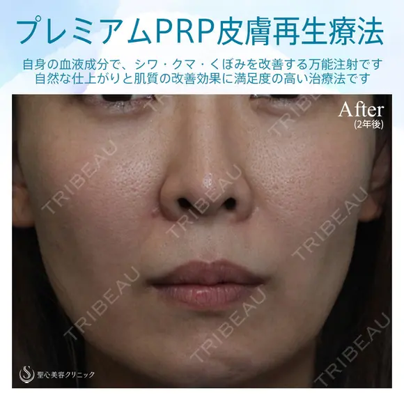 【女性・ほうれい線、たるみ改善後２年経過】プレミアムPRP皮膚再生療法（２年後） after画像 メイン用
