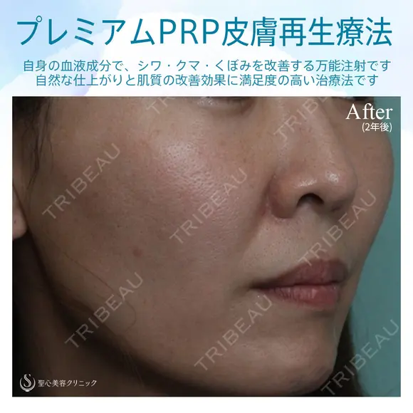 【女性・ほうれい線、たるみ改善後２年経過】プレミアムPRP皮膚再生療法（２年後） after画像 メイン用