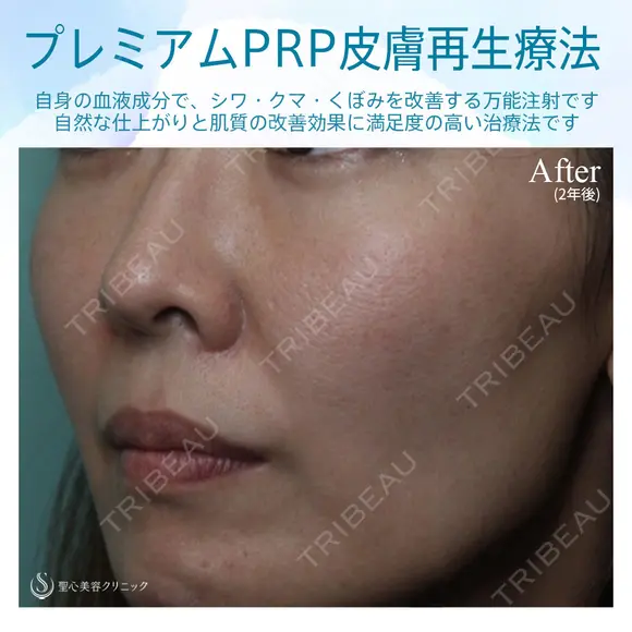 【女性・ほうれい線、たるみ改善後２年経過】プレミアムPRP皮膚再生療法（２年後） after画像 メイン用