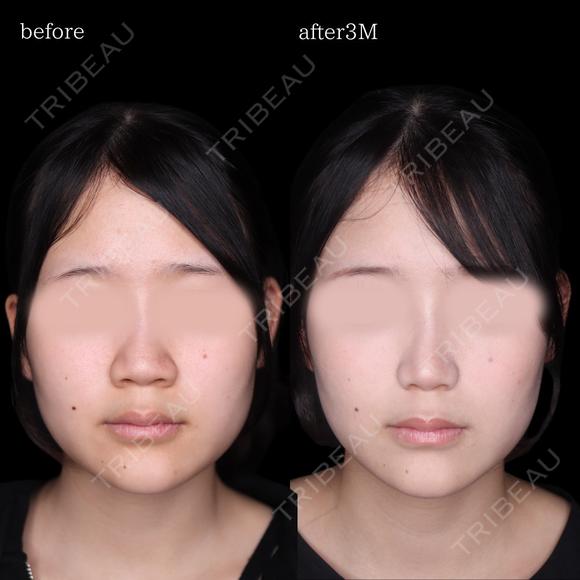 小鼻縮小内外法 after画像 メイン用