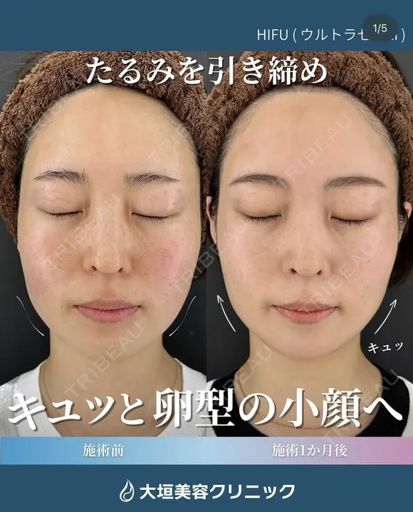 ハイフ　ウルトラセルzi before画像 メイン用