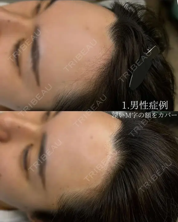 ヘアラインアートメイク after画像 メイン用