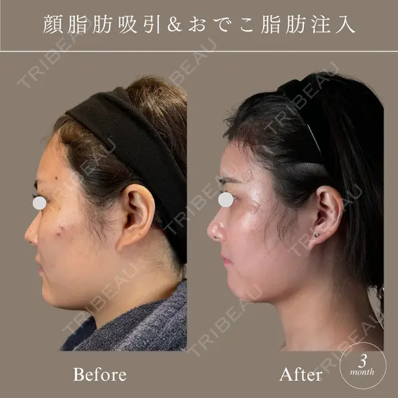 顔脂肪吸引、脂肪注入 before画像 メイン用