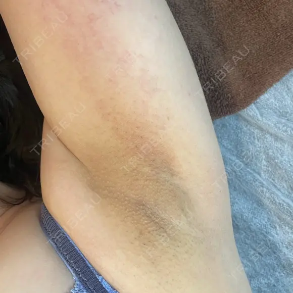 Body黒ずみケアセット脇６回 before画像 メイン用