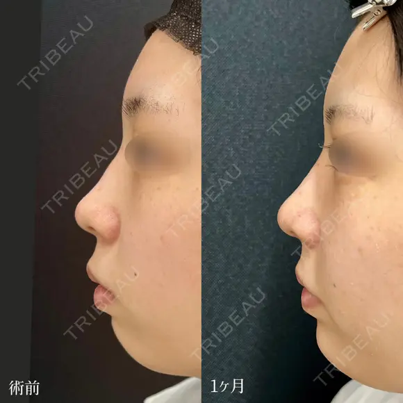 鼻尖形成3D法、軟骨移植、あごヒアルロン酸、あごボツリヌス注射 before画像 メイン用