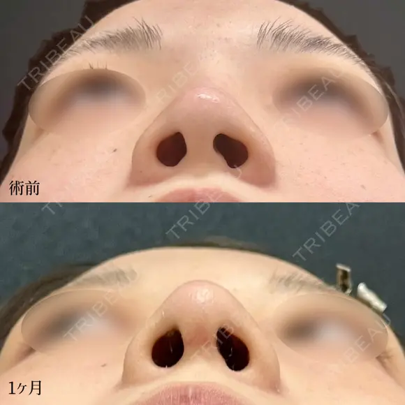 鼻尖形成3D法、軟骨移植、あごヒアルロン酸、あごボツリヌス注射 before画像 メイン用