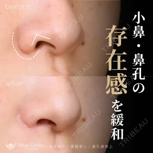 小鼻縮小・鼻翼挙上・鼻孔縁挙上 180日後 メイン用