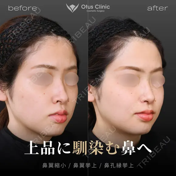 小鼻縮小・鼻翼挙上・鼻孔縁挙上 before画像 メイン用