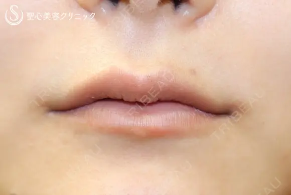 【20代女性・スマイルリップ】ヒアルロン酸＆スマイルボトックス（注入直後） before画像 メイン用