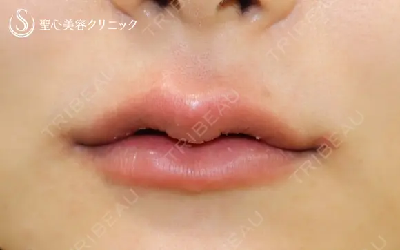 【20代女性・スマイルリップ】ヒアルロン酸＆スマイルボトックス（注入直後） after画像 メイン用