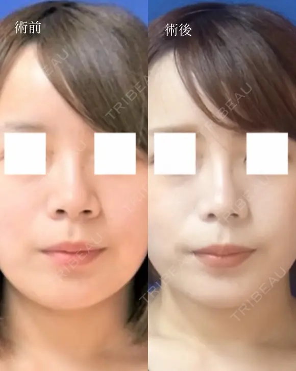 鼻尖縮小＋鼻翼縮小（外側） before画像 メイン用