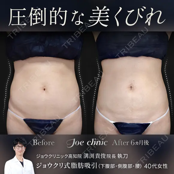 脂肪吸引（腹部） before画像 メイン用