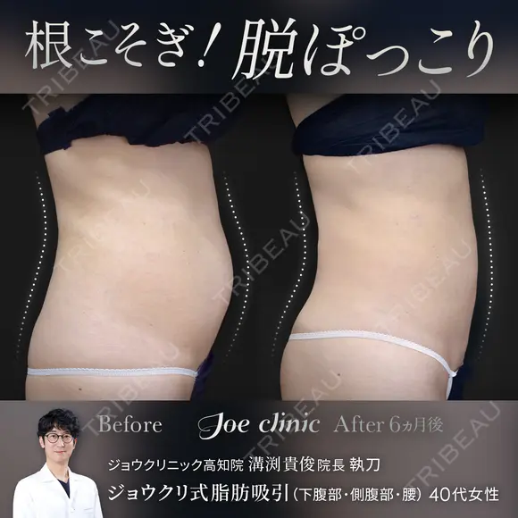 脂肪吸引（腹部） 180日後 メイン用
