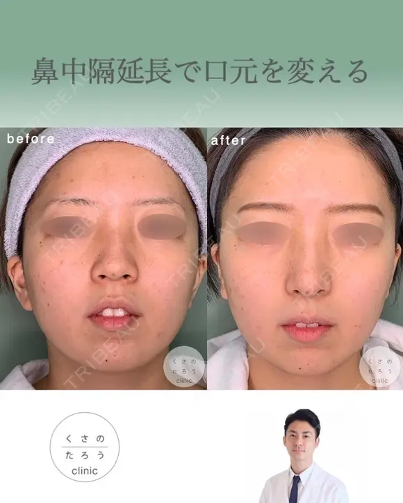 鼻中隔延長で口元をきれいにする after画像 メイン用