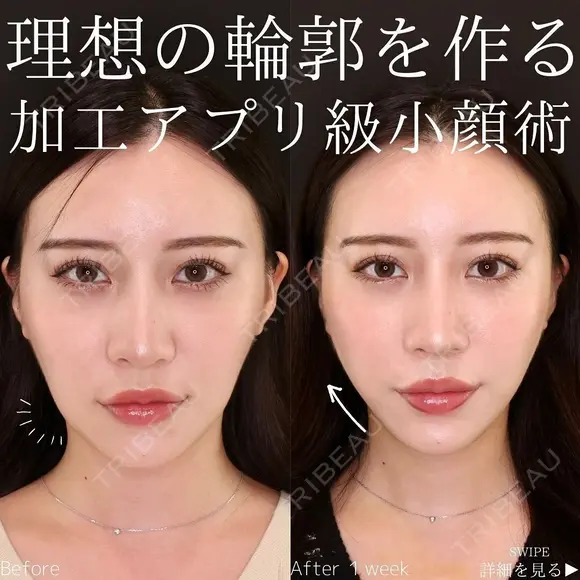 糸リフト＋脂肪吸引 30日後 メイン用