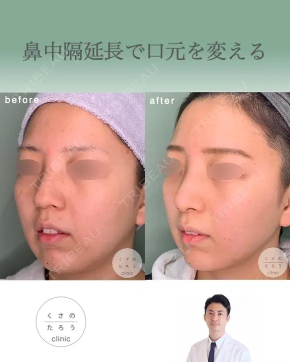 鼻中隔延長で口元をきれいにする after画像 メイン用
