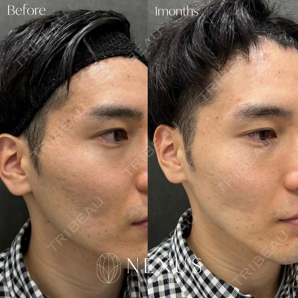 サブシジョンやり放題 × ジュベルック ドクター手打ち全顔（1回） before画像 メイン用